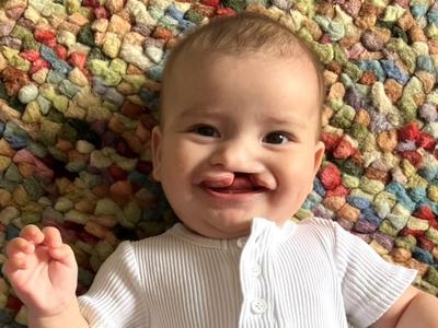 Creating a lifetime of smiles for the 1 in 700 cleft babies like Bowie.