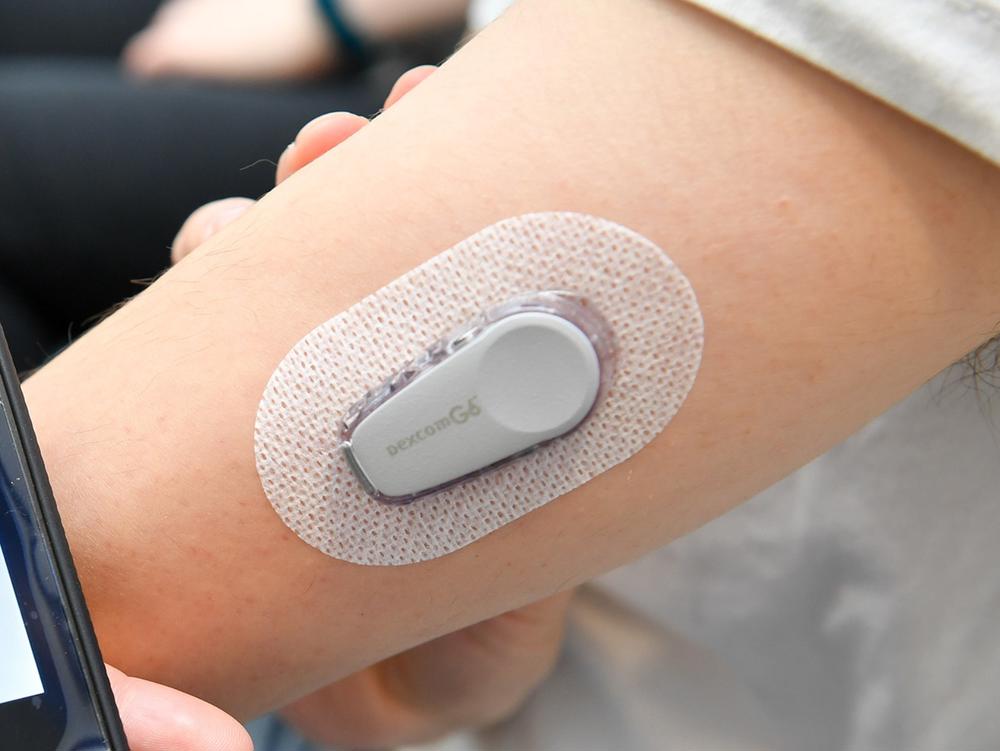 Dexcom g6 placement best spots on your body to wear it 59 off