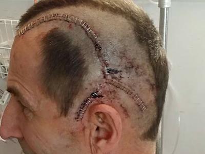 The median survival time with Glioblastoma is 15 months - I’m running to change that. 