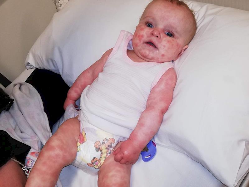 Baby Harper needs your help to fight this rare disease ...
