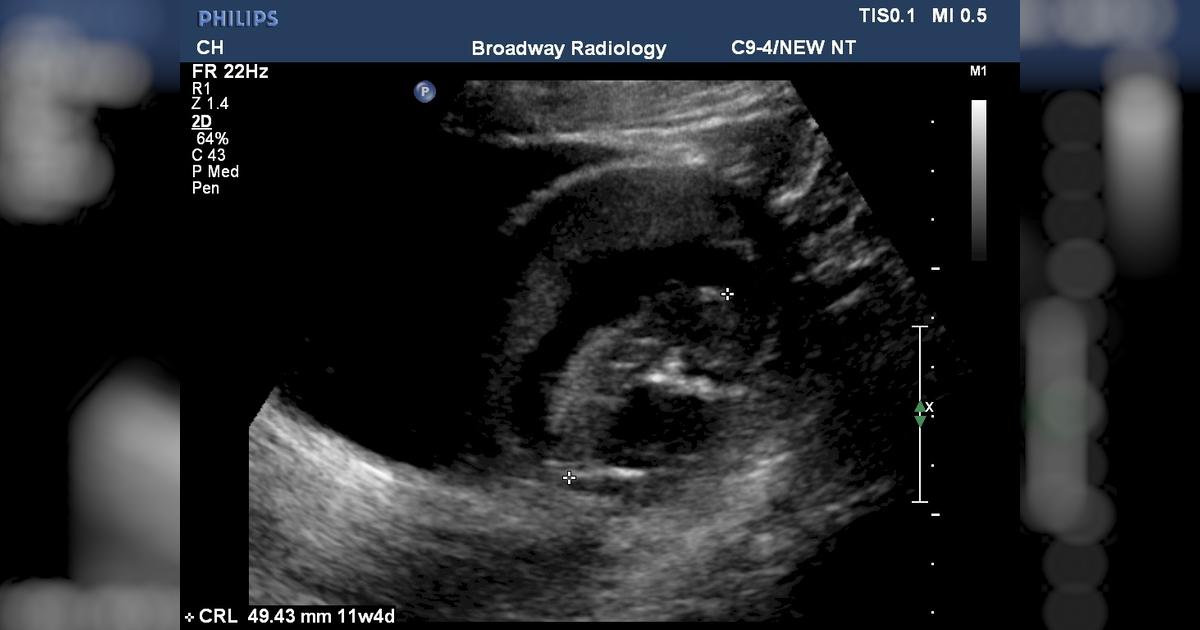 Potter's Syndrome Givealittle