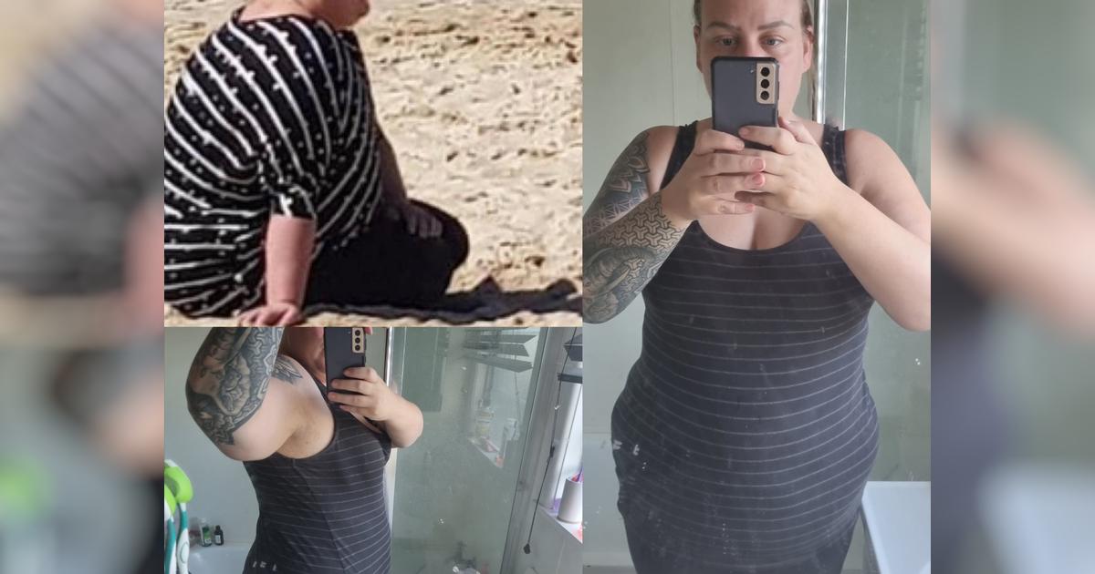 Skin removal surgery Givealittle