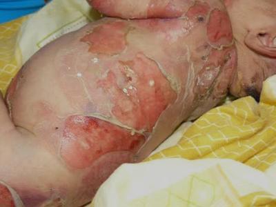 Be a real hero and donate what you can and bring a smile to these poor children that are living with this painful skin condition