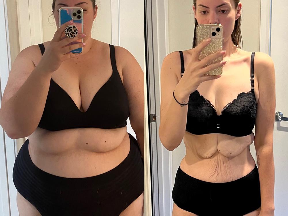 100kg Weight Loss Transformation Excess Skin Removal Surgery 