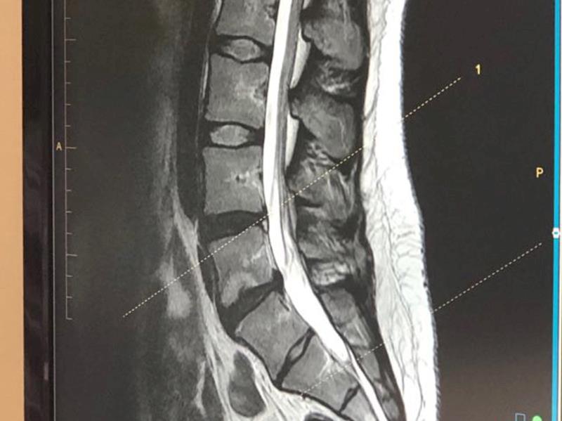 Help Meg pay for L4L5 and L5S1 disc replacement surgery